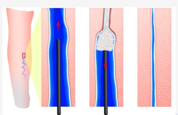 Склеротерапия: эффективный метод лечения варикозного расширения вен