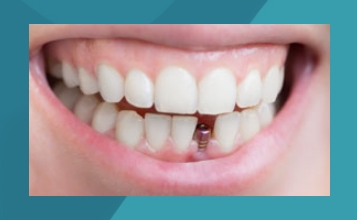 Имплантация передних зубов: как вернуть улыбку без компромиссов